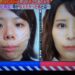 訳あり人の駆け込み寺！整形女25才(美雪)の前後顔画像！口元チンパンジーと壮絶イジメも600万で大変身！
